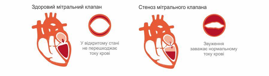 Мітральний стеноз