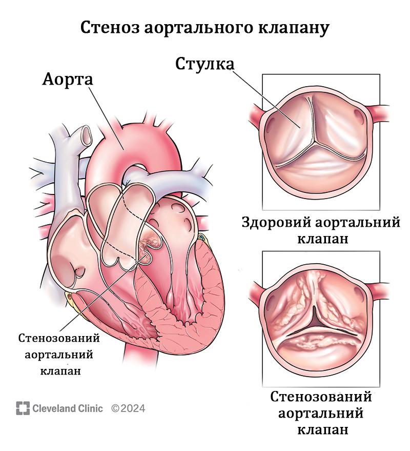 Операция Озаки