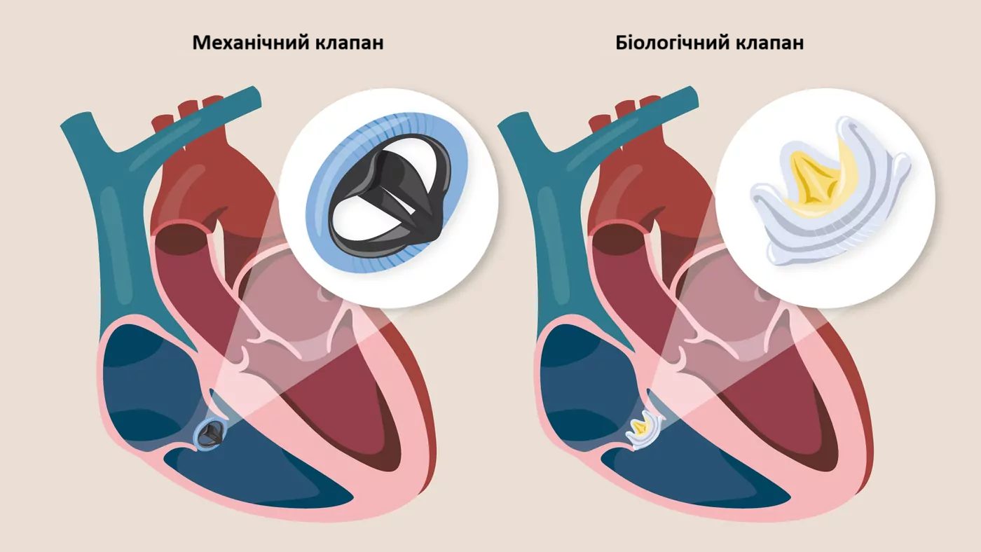 Основні етапи проведення операції при патологіях тристулкового клапана