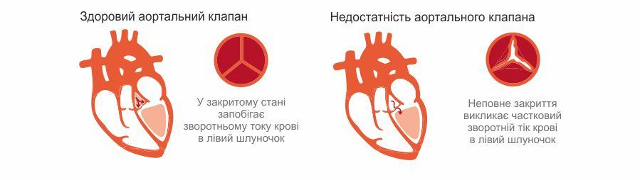 Аортальна регургитация (недостатность)