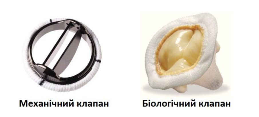 протезування клапана