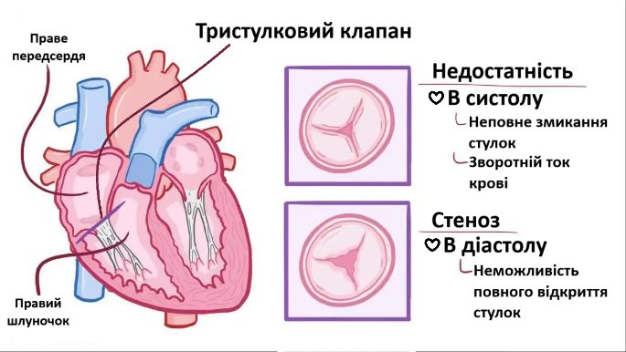 Патологія тристулкового клапана