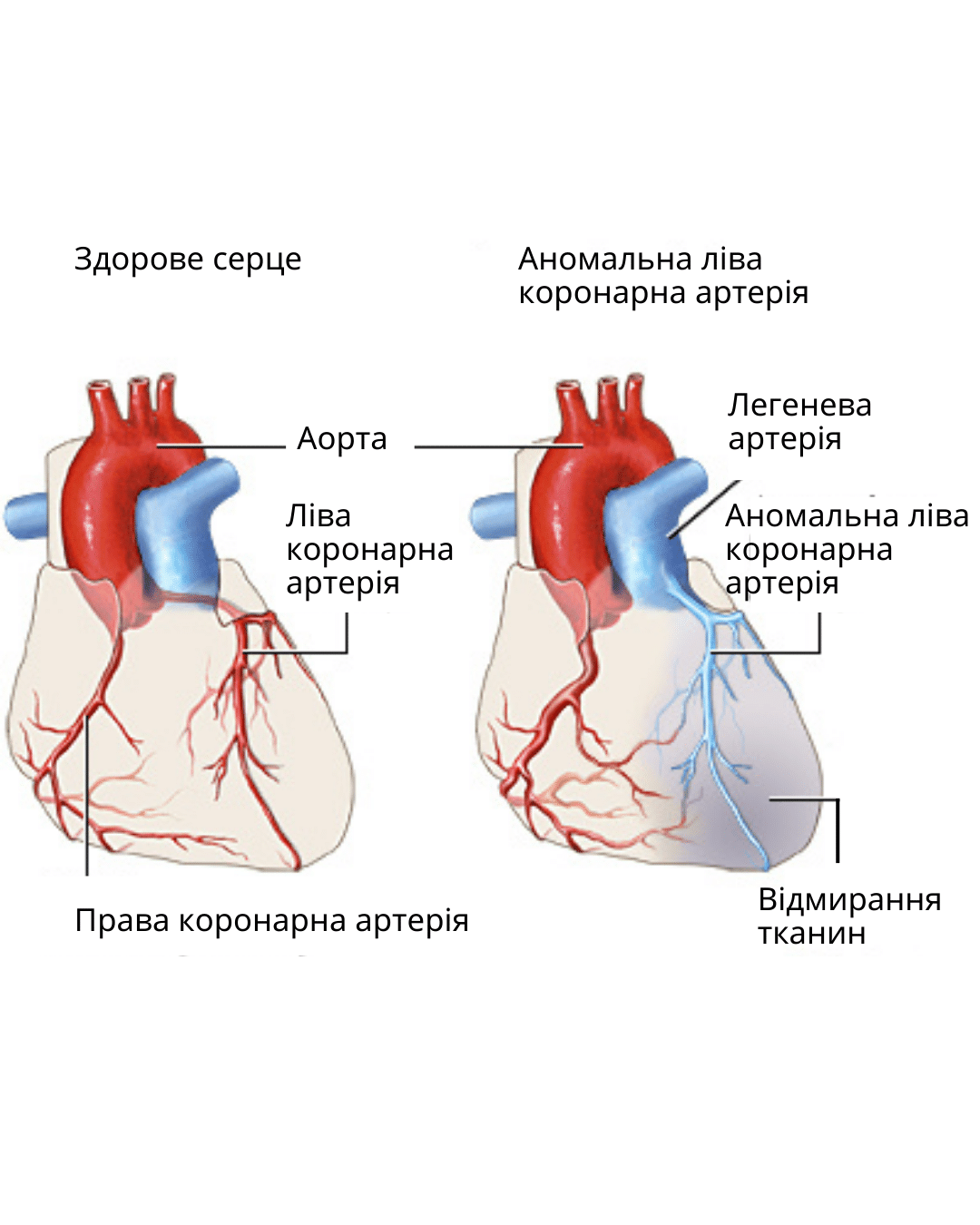 Аномальне відходження коронарної артерії від легеневої артерії у дітей