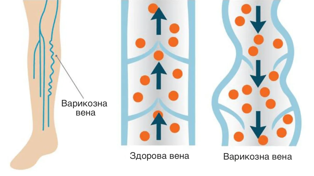 Хронічна венозна недостатність (ХВН) і варикозна хвороба вен нижніх кінцівок