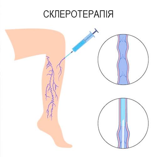 склеротерапія