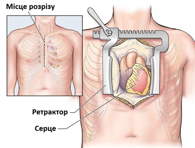Хід комбінованої операції (залежить від об’єму втручання)