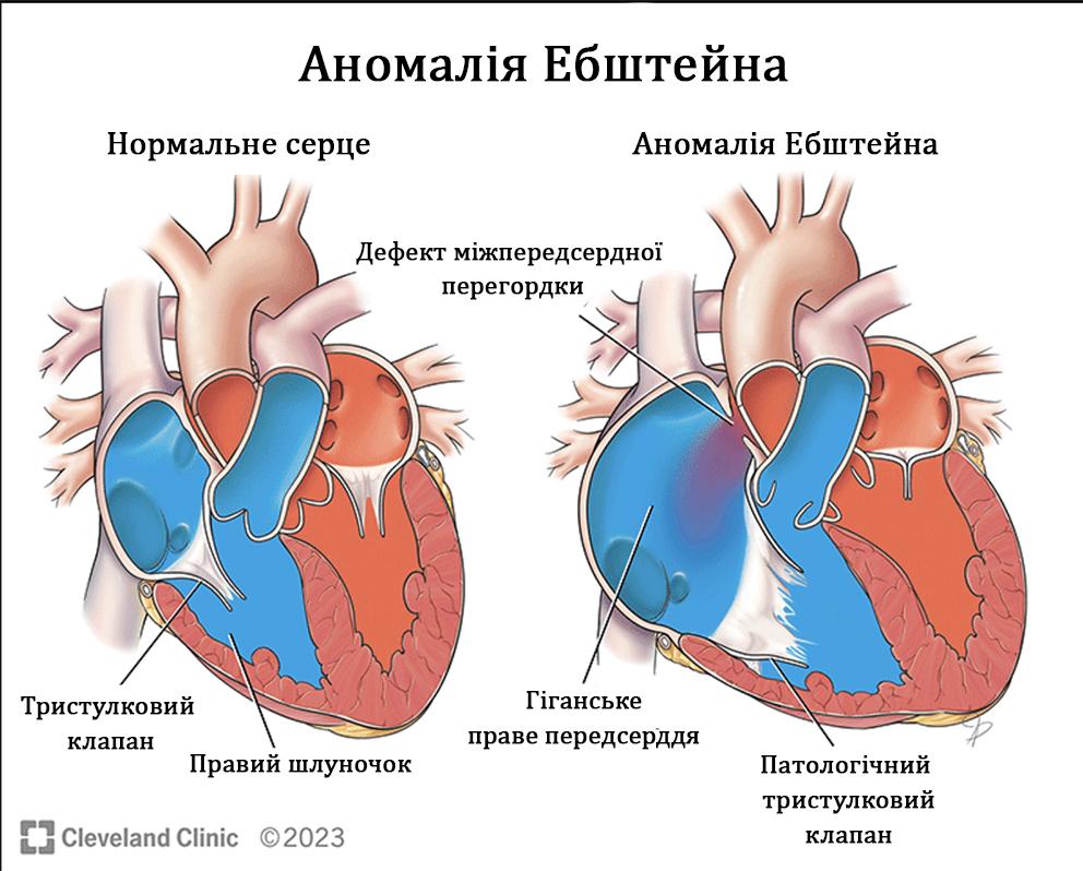 Аномалія Ебштейна 