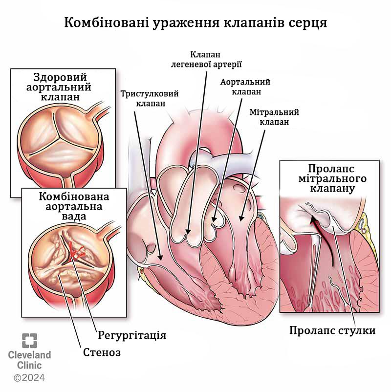 комбіновані ураження клапанів серця